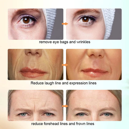 RF EMS Facial Massager